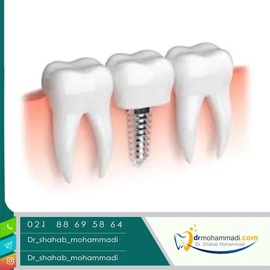 راهنمای جامع قیمت مینی ایمپلنت دندان